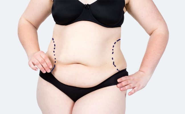 lipolift-mc-t-gooi-1