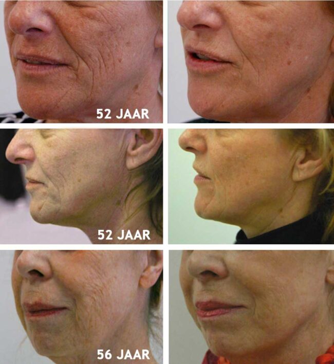 gefractioneerde-laserbehandeling-2