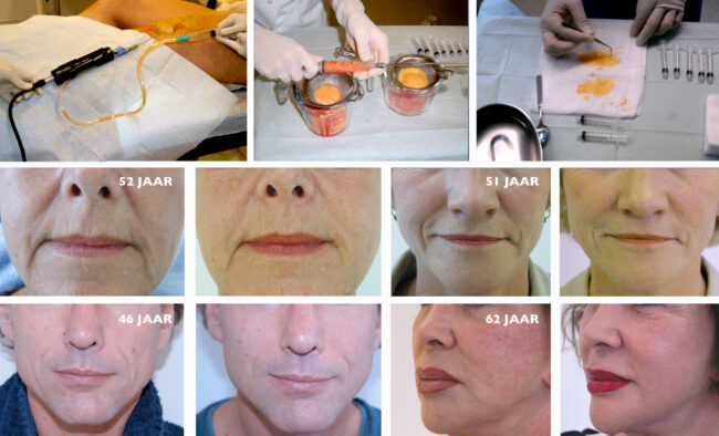 lipofilling-mcgooi2