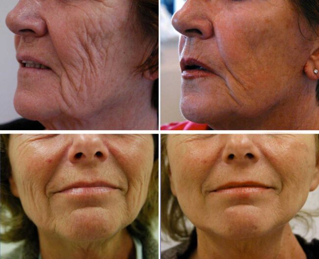 minilift-s-lift-mcgooi-2